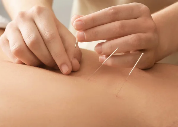 acupuncture