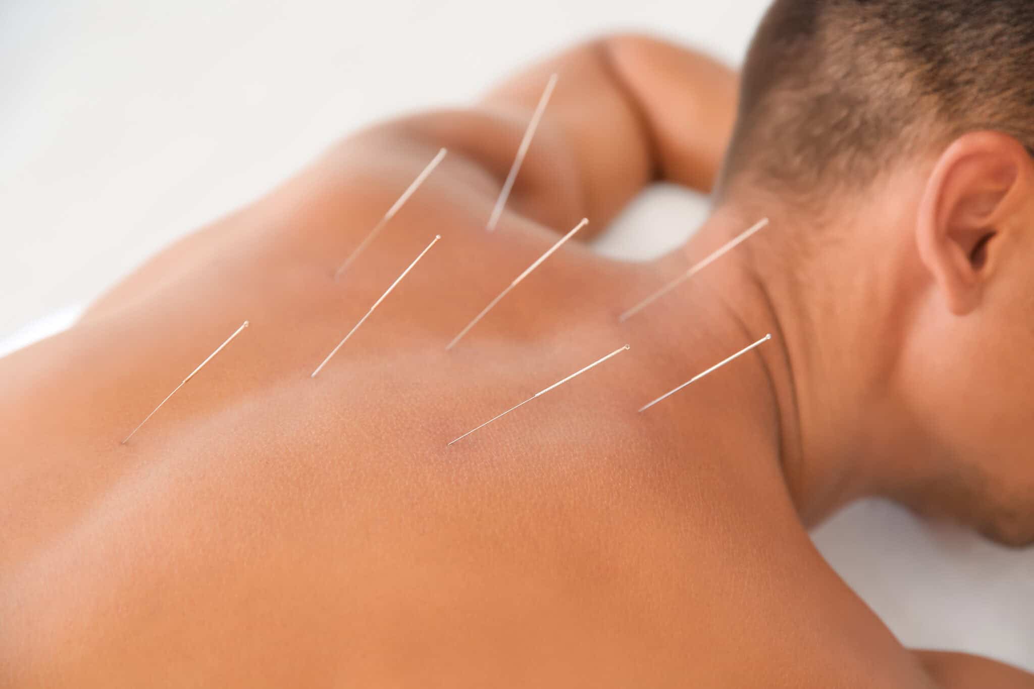 man having acupuncture treatment on her back